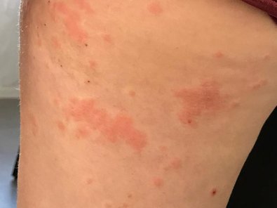 Allergic skin reactions 